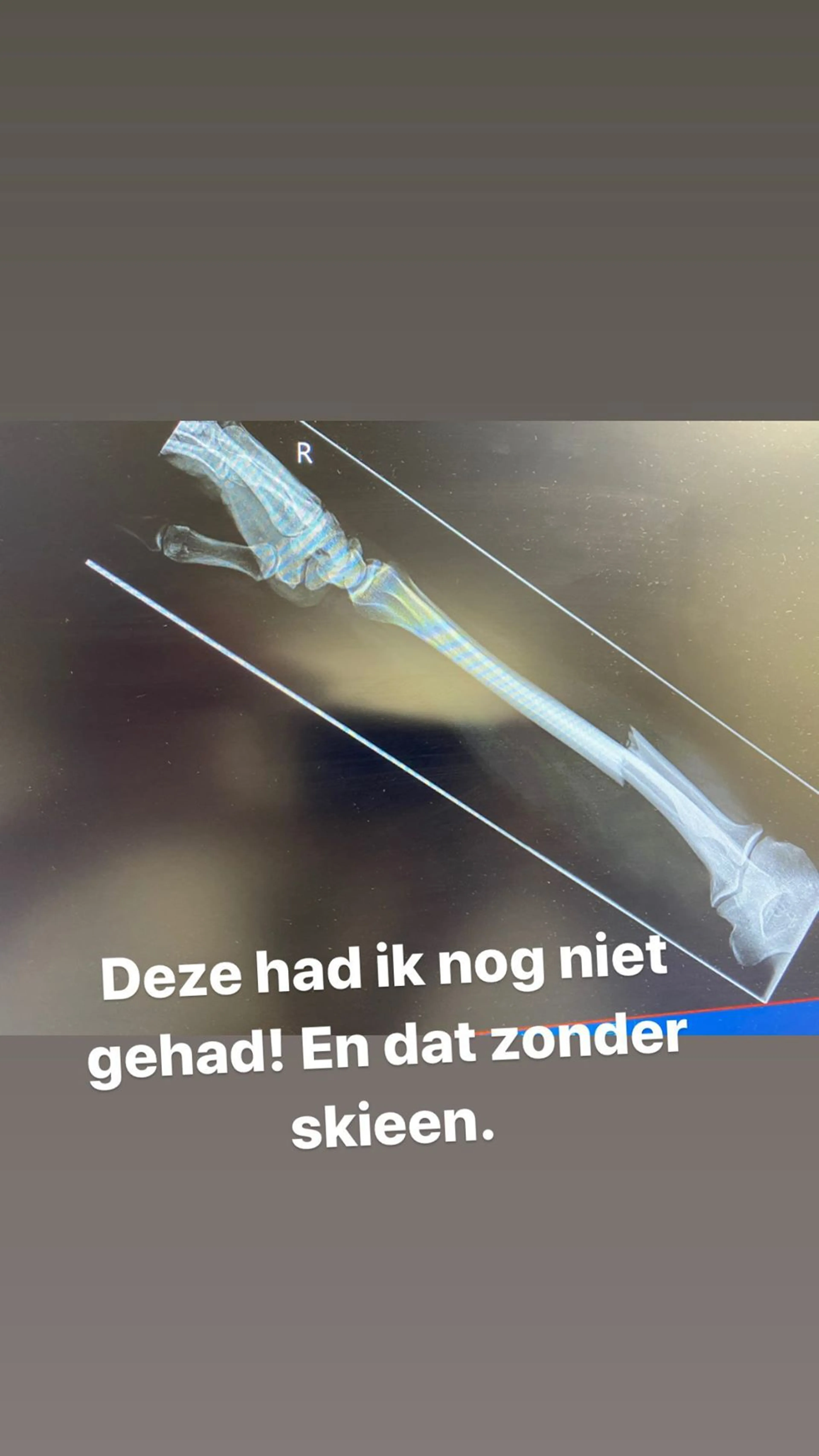 UPDATE: Wolter Kroes moet onder het mes