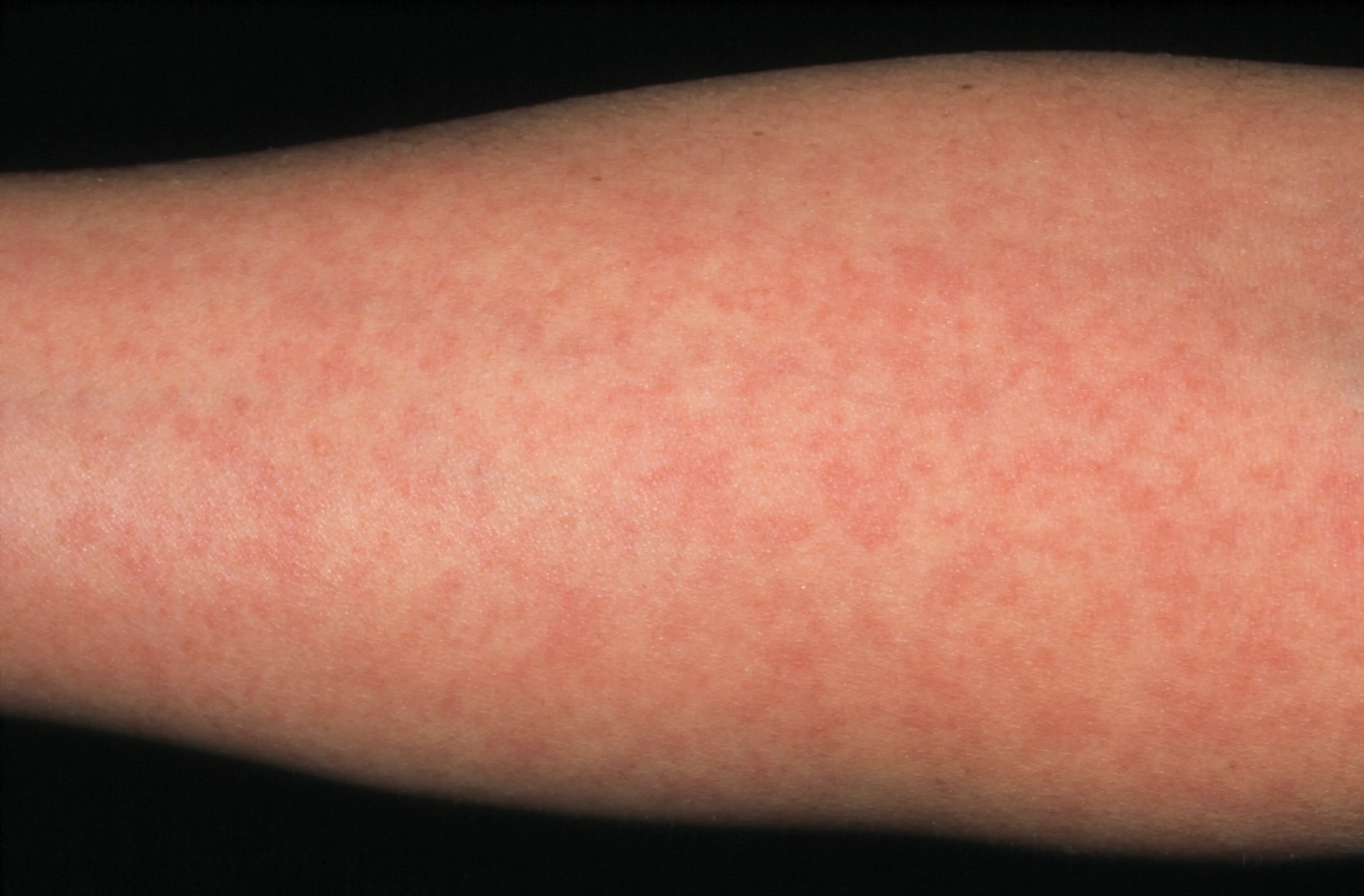 WHO over hoogste aantal mazelengevallen: vaccinatiegraad moet dringend omhoog
