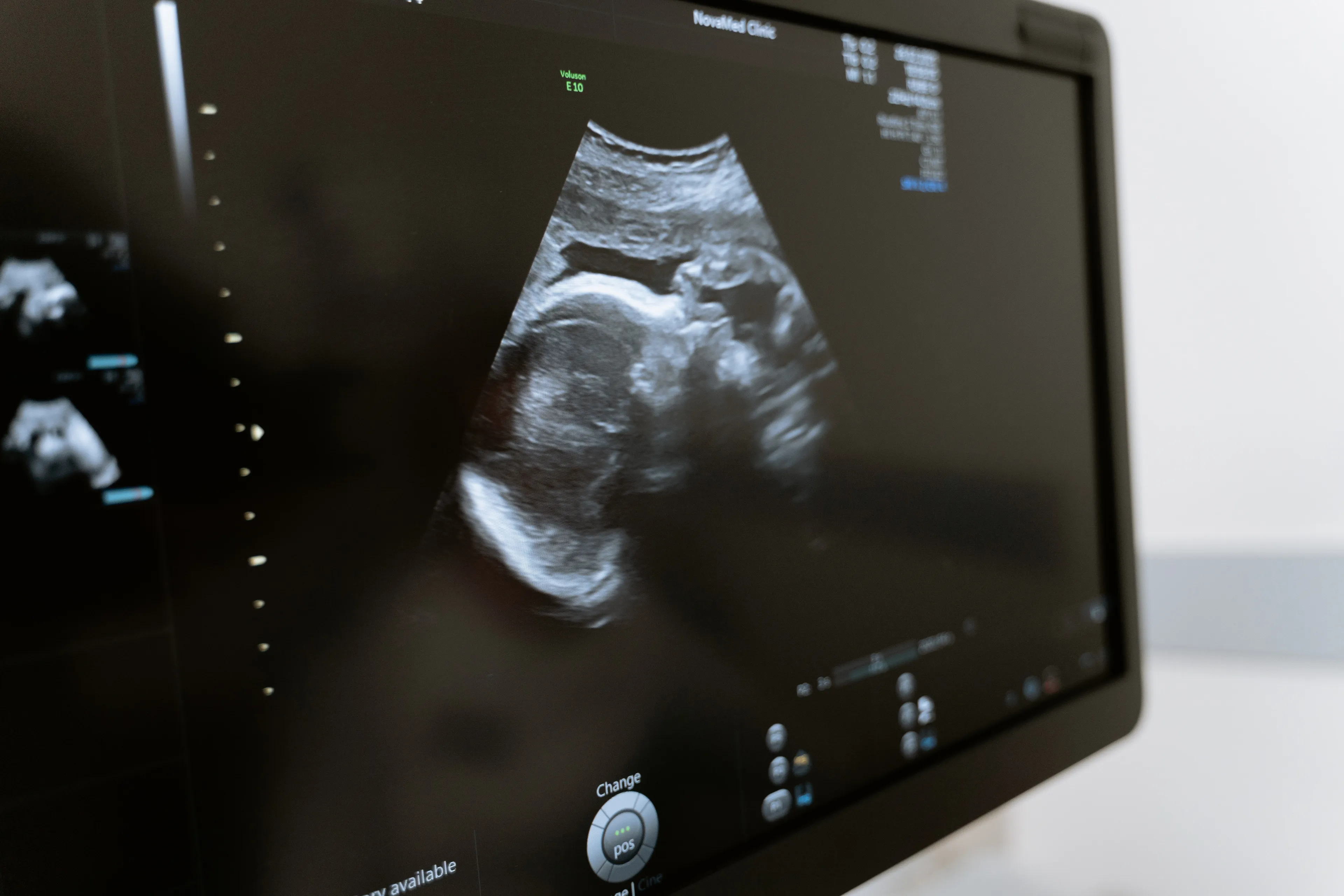 Minder complicaties na extra echometing bij hoogzwangere vrouwen