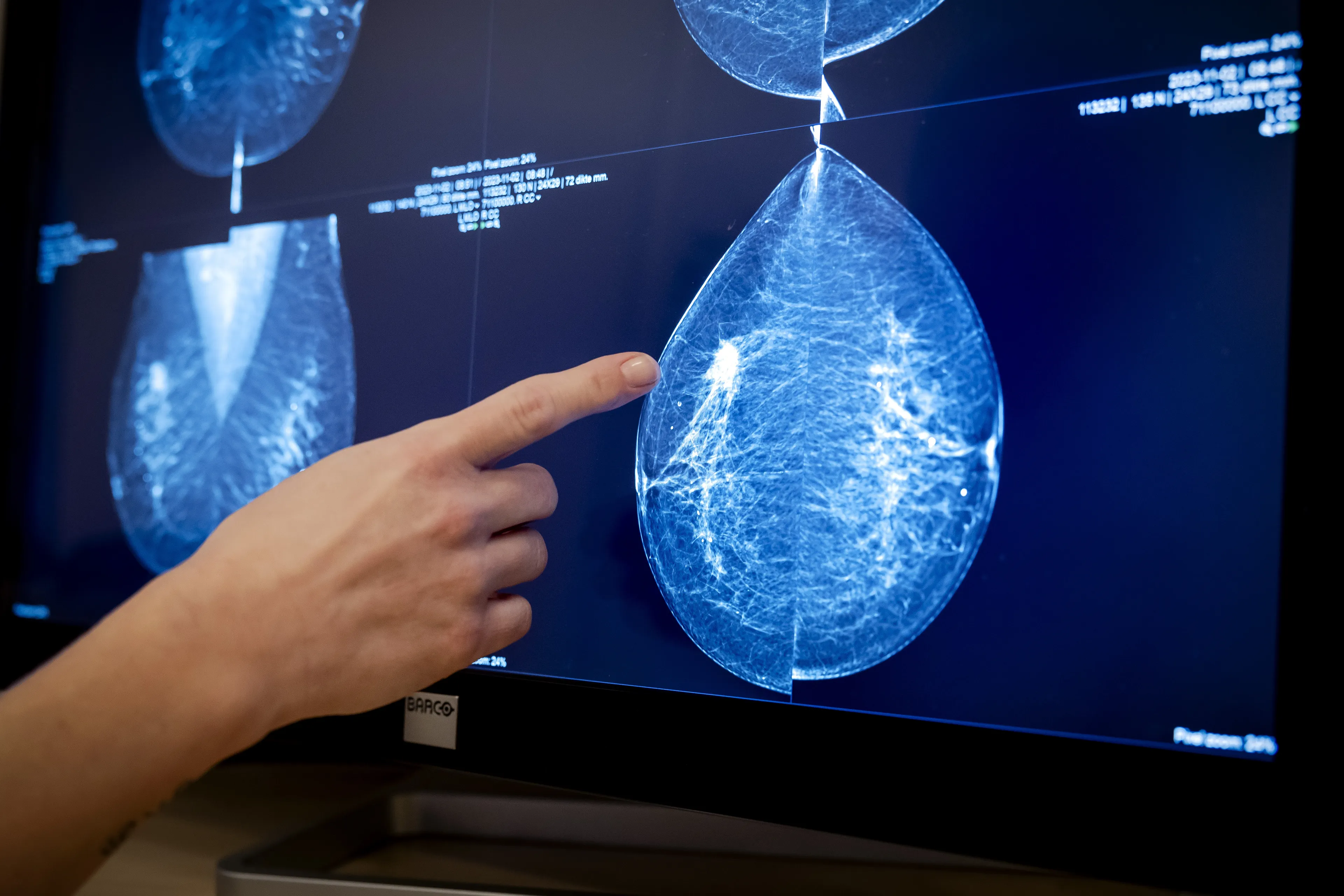 Borstkankermedicijn Trodelvy toch opgenomen in basisverzekering