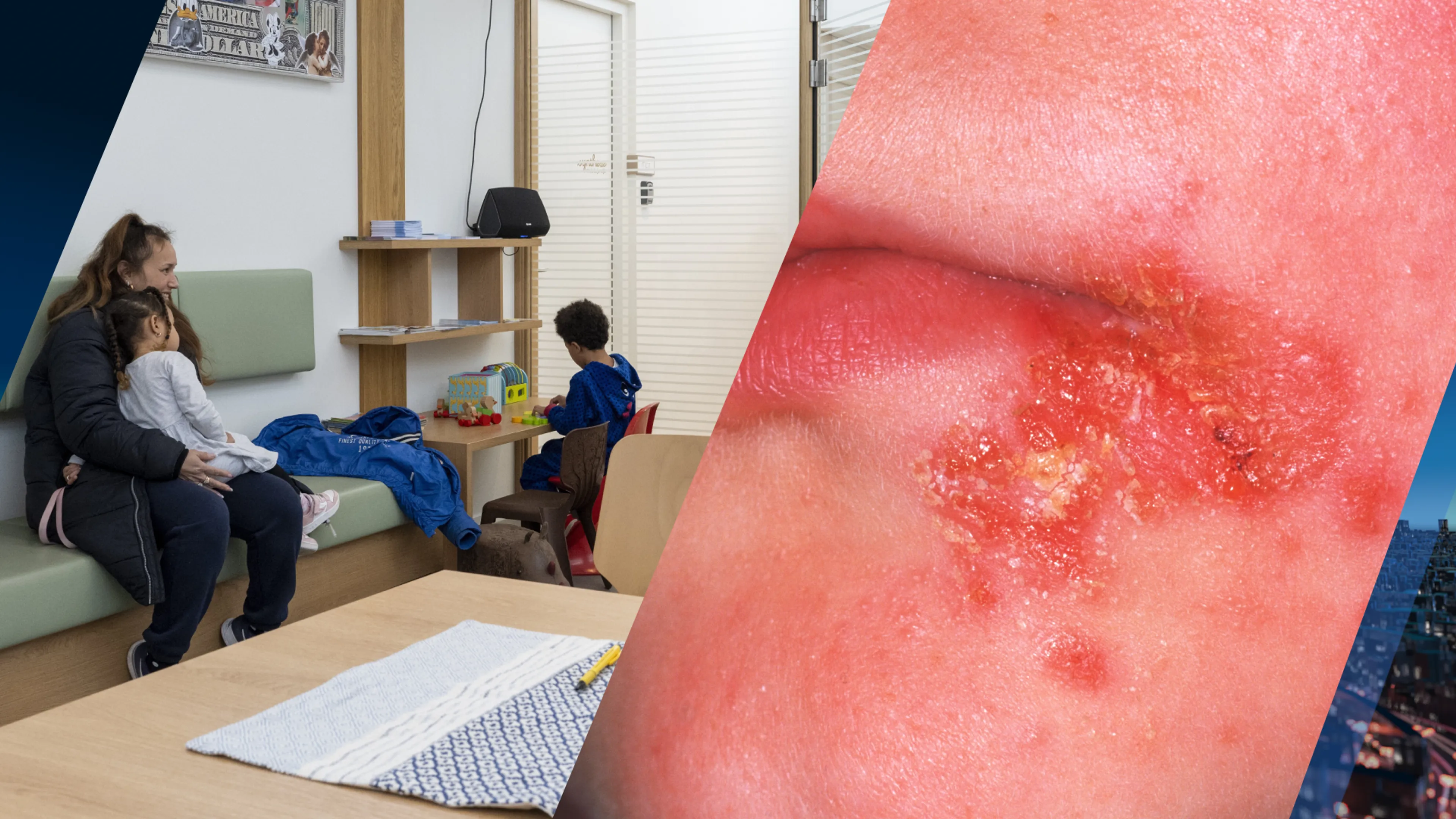 Veel kinderen hebben nu krentenbaard: dit kun je doen om het te voorkomen