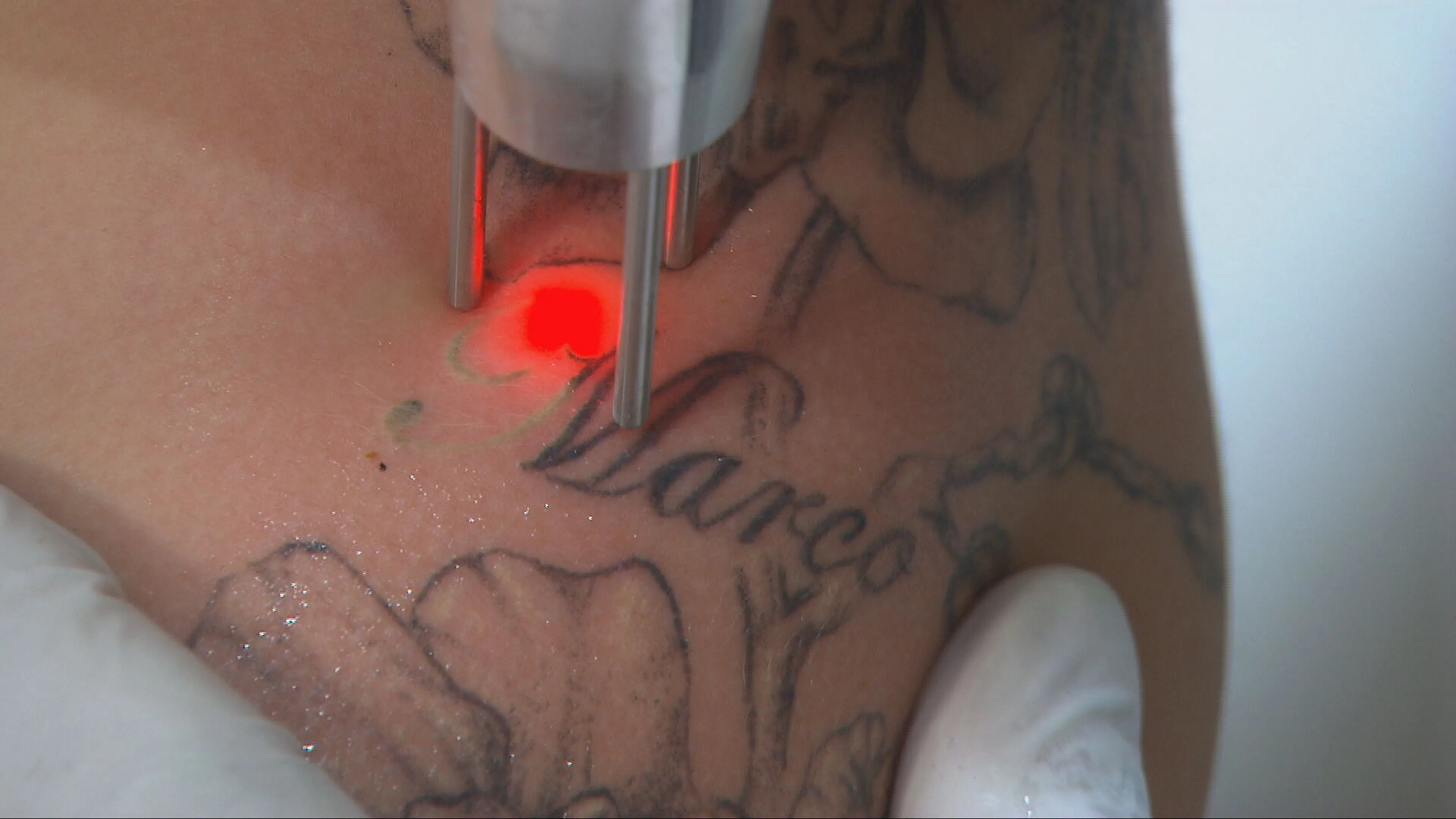 'Alarm om wildgroei tattooverwijdering: risico’s groot'