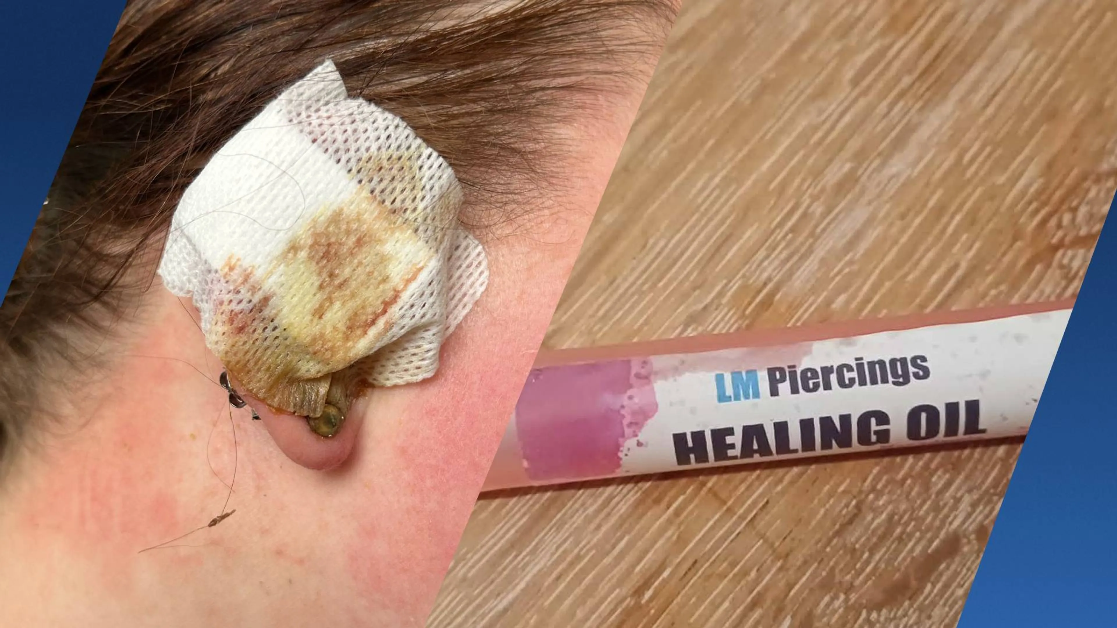 Ongeveer 150 mensen kregen ontstekingen door piercingspray